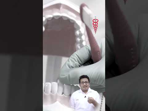 Type of Dental Implants